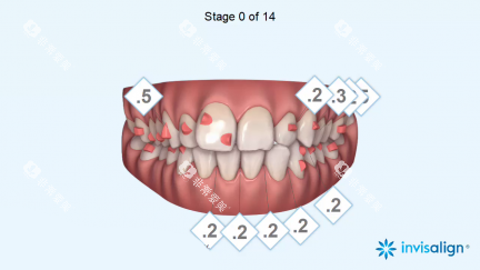 隐适美病例设计 隐适美病例设计