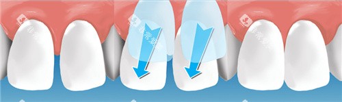 门牙贴面过程 门牙贴面过程