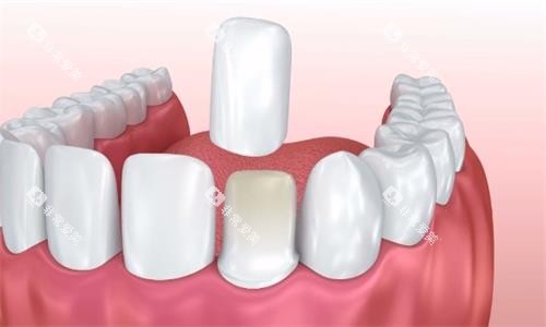 牙贴面动画展示图 牙贴面动画展示图