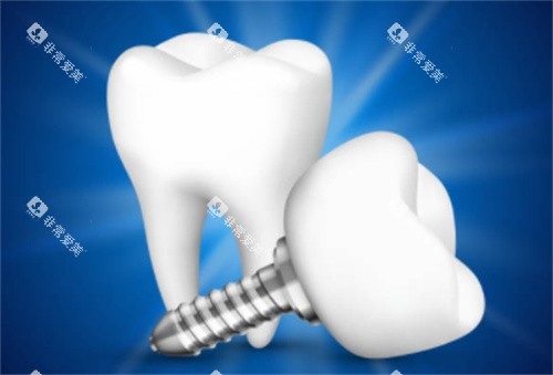 2颗种植牙模型图 2颗种植牙模型图