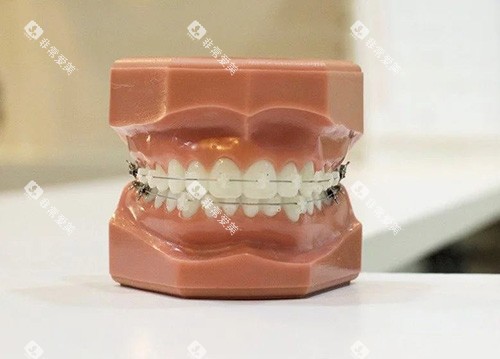牙齿矫正陶瓷托槽牙套模型 牙齿矫正陶瓷托槽牙套模型