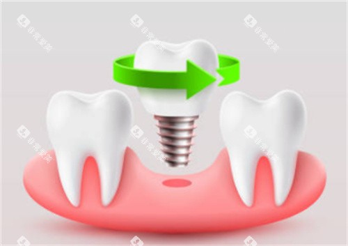 种植牙拧在牙床图 种植牙拧在牙床图