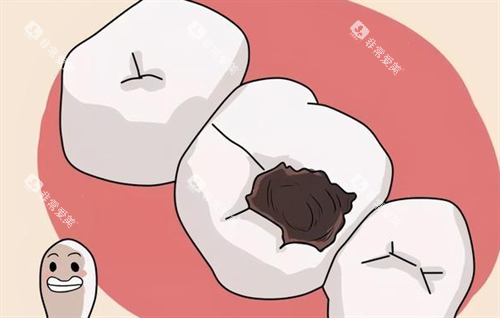 龋齿图片：重度龋齿动画展示