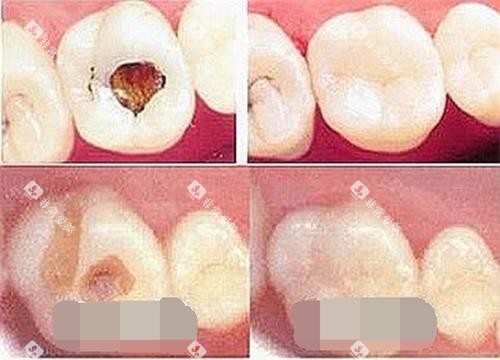 补牙前后展示图 补牙前后展示图