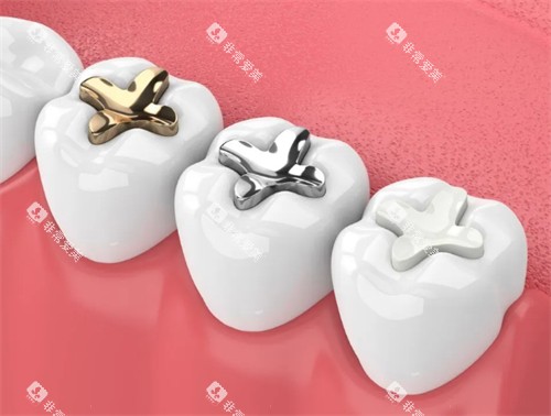 不同材质的补牙材料 不同材质的补牙材料