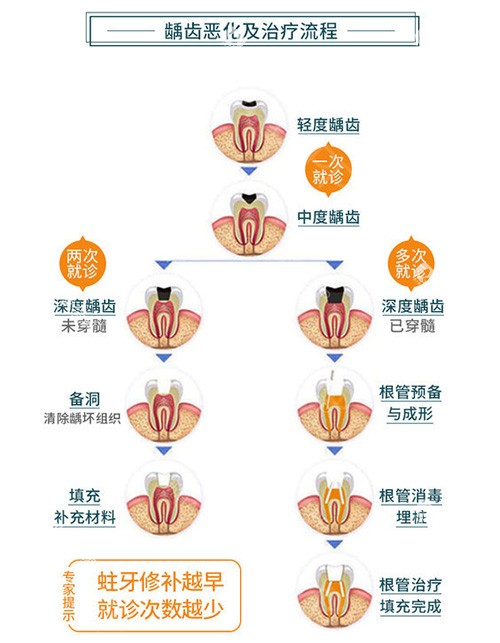 龋齿恶化示意图