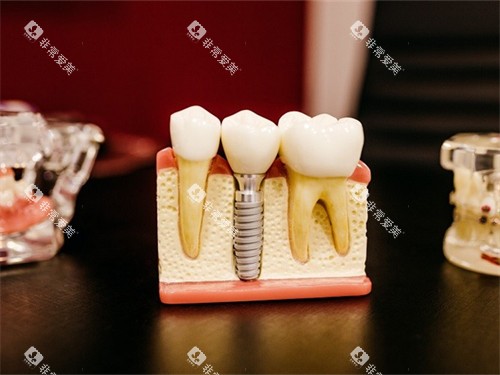种植牙的牙齿模型展示图 种植牙的牙齿模型展示图