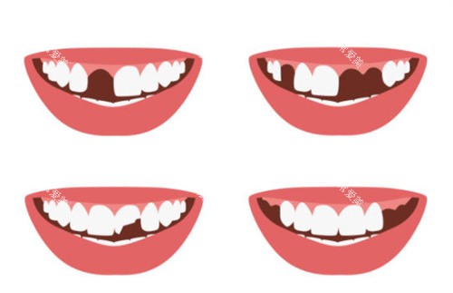 牙齿缺失图