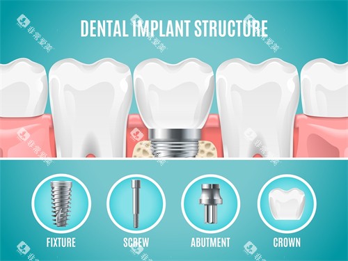 种植牙植体组成部分展示 种植牙植体组成部分展示