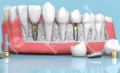 种植牙材料动画展示 种植牙材料动画展示
