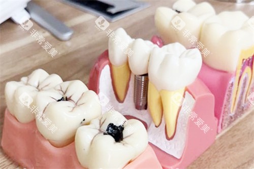 合肥靓美口腔医院种植牙模型