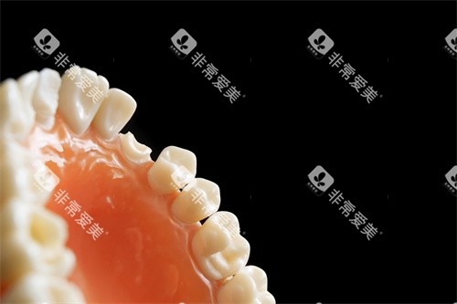 牙齿修复图示