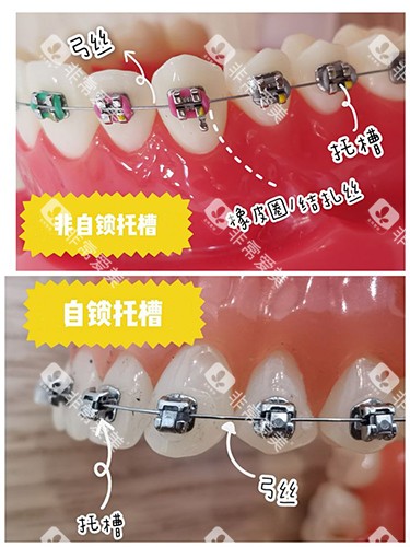 牙齿矫正自锁和非自锁牙套区别