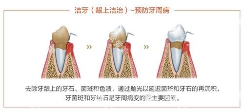 洗牙龈上洁治过程示意图
