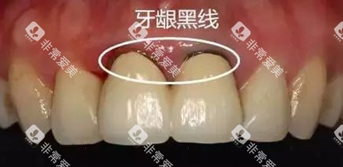 牙龈黑线示意图