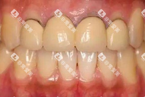 烤瓷冠牙龈黑线