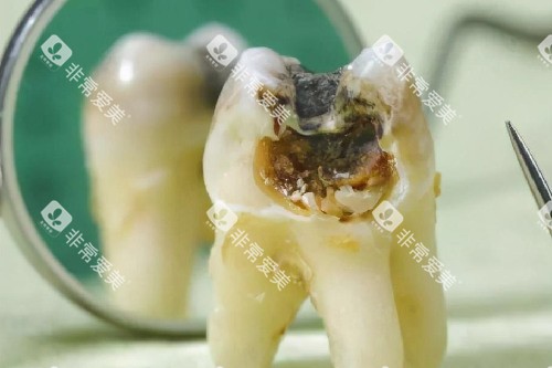 牙齿从根部开始烂图片