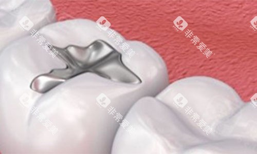 银汞合金补牙 银汞合金补牙