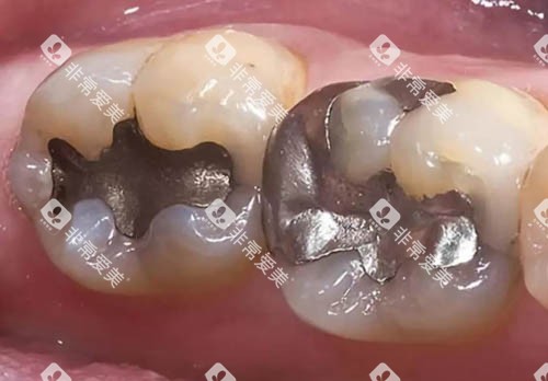 金属材料补牙细节图