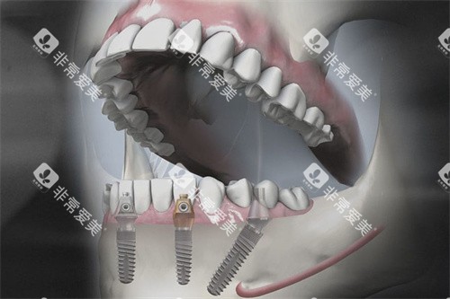 德国SKY种植牙模拟图