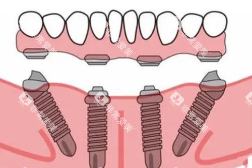 all-on-4种植模型展示图