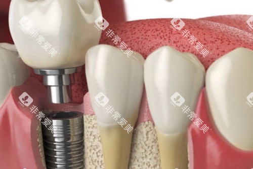 种植体分解图 种植体分解图