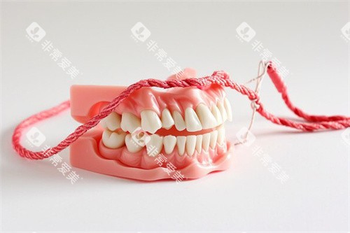 排龈线假牙模型 排龈线假牙模型