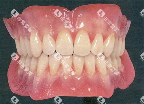 活动假牙全口示意图 活动假牙全口示意图