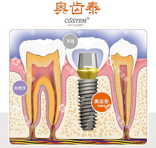 奥齿泰示意图 奥齿泰示意图