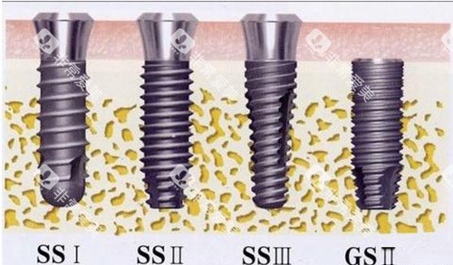 奥齿泰植体示意图 奥齿泰植体示意图
