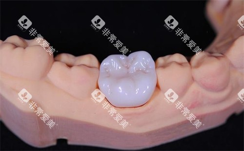 全瓷牙冠 全瓷牙冠