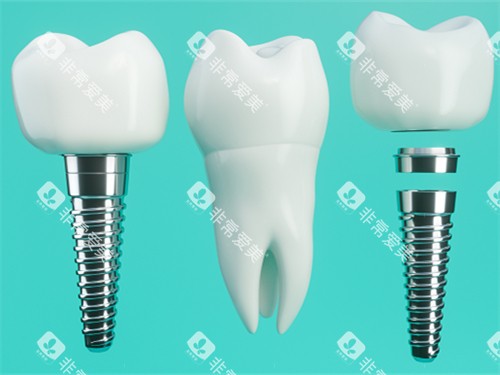 种植牙和真实牙齿漫画示意图