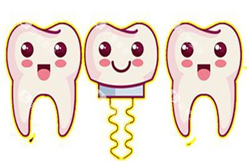 种植牙卡通示意图