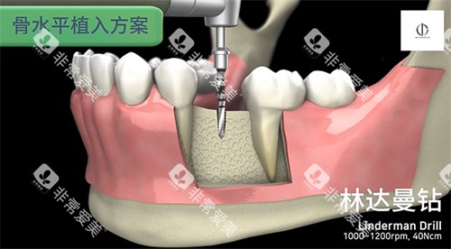 韩一种植体植入步骤 韩一种植体植入步骤