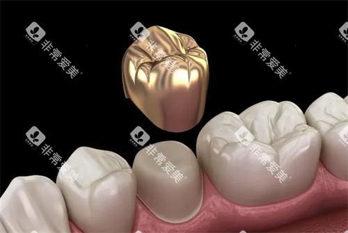 牙冠的材质 牙冠的材质