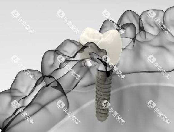 种植牙模拟图