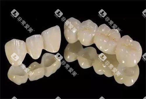 全瓷牙示意图 全瓷牙示意图
