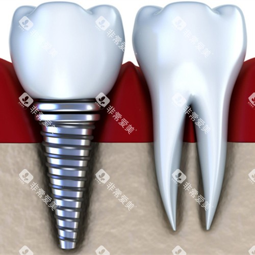 单颗种植牙展示图