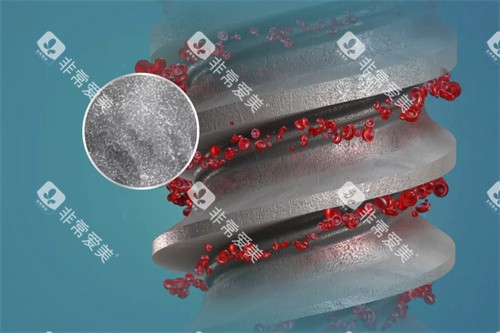 德国ABT种植牙表面结构