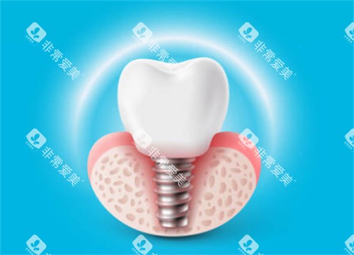 种植牙有光圈示意图 种植牙有光圈示意图