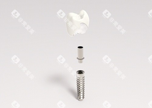 种植牙图片 种植牙图片