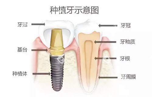 种植牙示意图 种植牙示意图