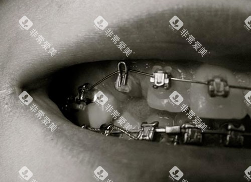 牙齿矫正牙套金属托槽牙套 牙齿矫正牙套金属托槽牙套