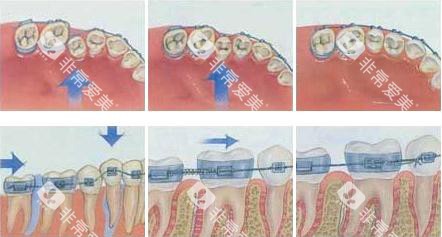 牙齿矫正移动过程示意图 牙齿矫正移动过程示意图