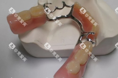 活动假牙模型图片展示