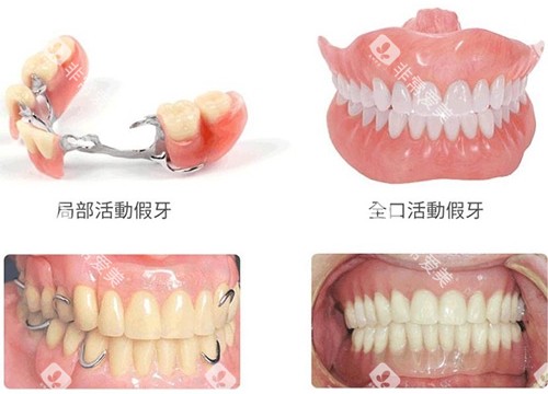 假牙多种方式展示