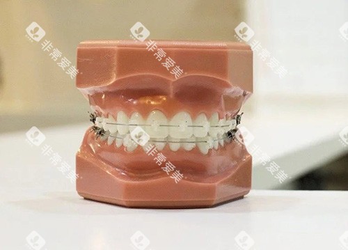 牙齿矫正陶瓷托槽牙套模型 牙齿矫正陶瓷托槽牙套模型