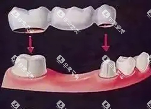 固定桥