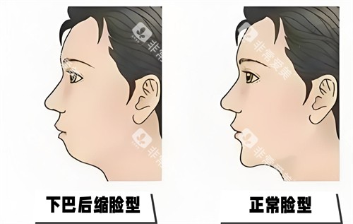 下巴后缩与正常脸型对比动画图 下巴后缩与正常脸型对比动画图