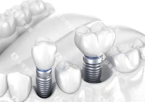 种植牙图片展示